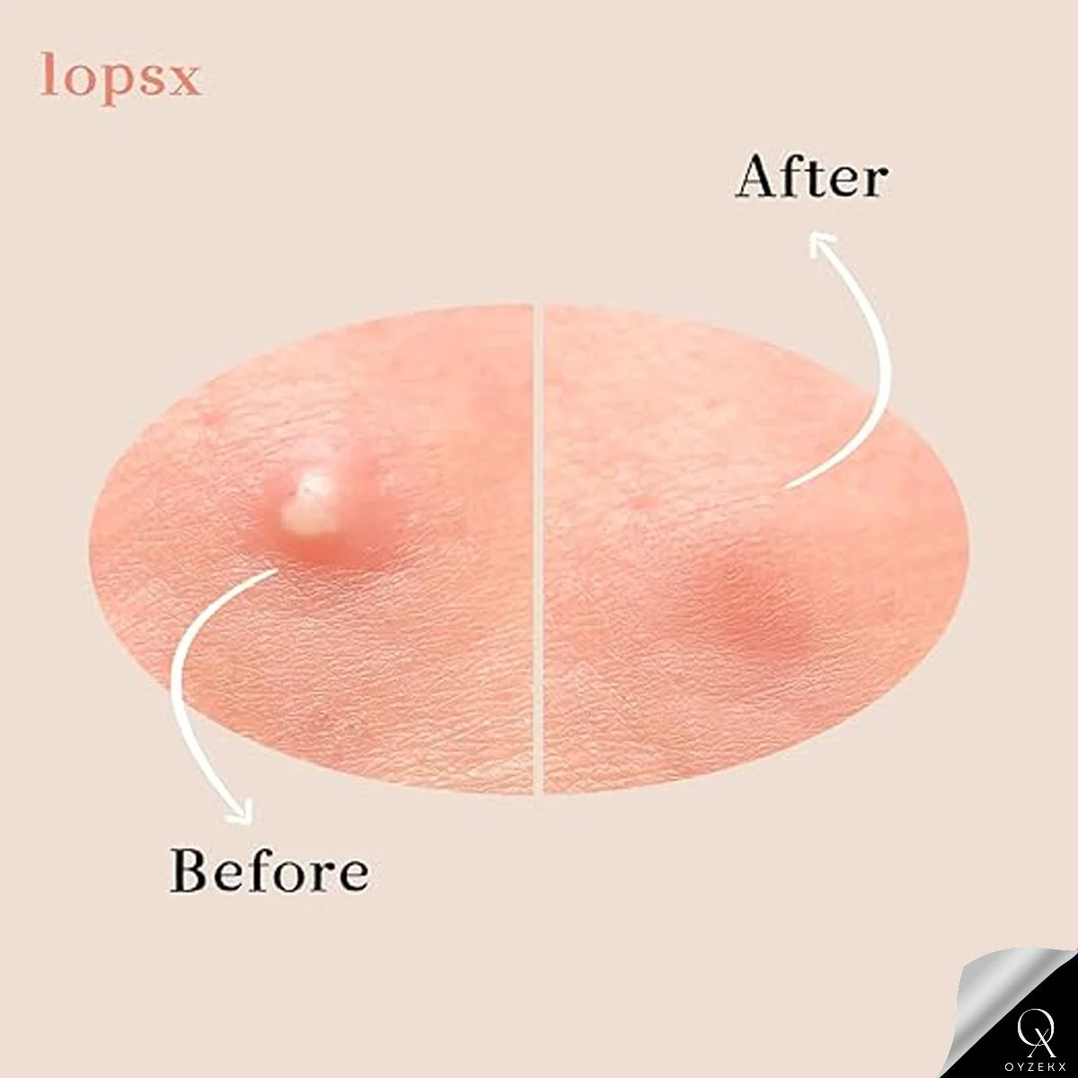 OyzekX Pimple Patch For Face | 36 Hydrocolloid Pimple Patches | 2% w/w Salicylic Acid, Neem, Cica | Helps Reduce Pimples, Redness & Irritation | Absorbs Excess Oil | Safe for All Skin Types (36 pcs-White)