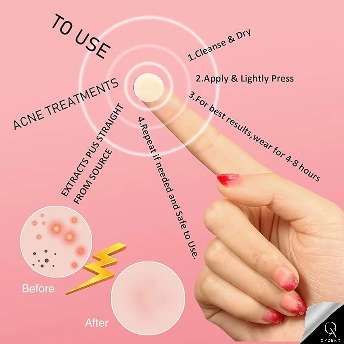 OyzekX Pimple Patch For Face | 36 Hydrocolloid Pimple Patches | 2% w/w Salicylic Acid, Neem, Cica | Helps Reduce Pimples, Redness & Irritation | Absorbs Excess Oil | Safe for All Skin Types (36 pcs-White)