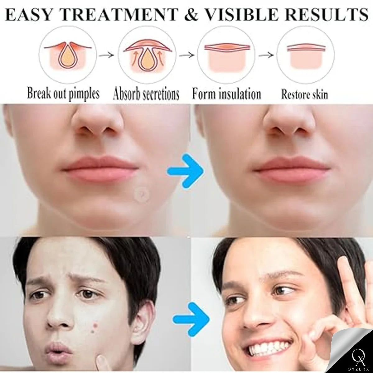 OyzekX Pimple Patch For Face | 36 Hydrocolloid Pimple Patches | 2% w/w Salicylic Acid, Neem, Cica | Helps Reduce Pimples, Redness & Irritation | Absorbs Excess Oil | Safe for All Skin Types (36 pcs-White)